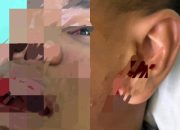 Siswa SMAN 1 Matauli Pandan Diduga Dipersekusi Geng Sekolah, Alami Luka Serius