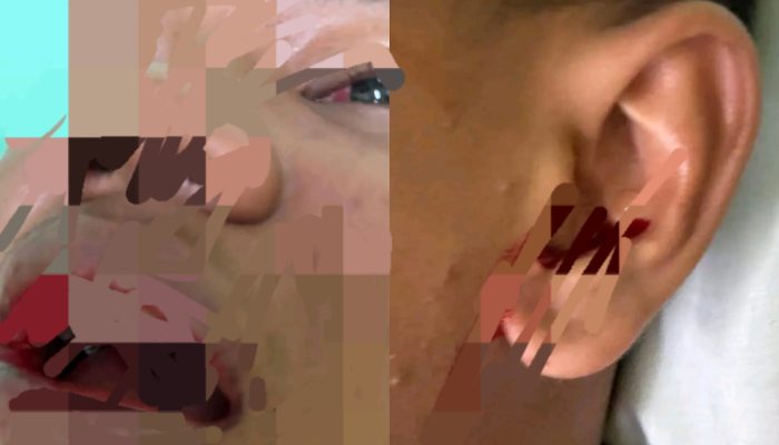 Siswa SMAN 1 Matauli Pandan Diduga Dipersekusi Geng Sekolah, Alami Luka Serius